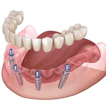 Illustration of dentures being attached to All-on-4 dental implants in Morgan Hill