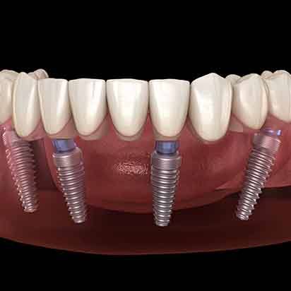 Illustration of All-on-4 in the lower arch