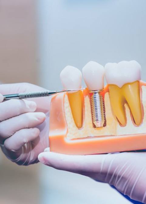 Dentist pointing to a dental implant that’s part of a dental model