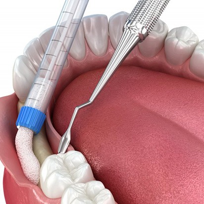 Digital image of bone grafting being adding to the jawbone