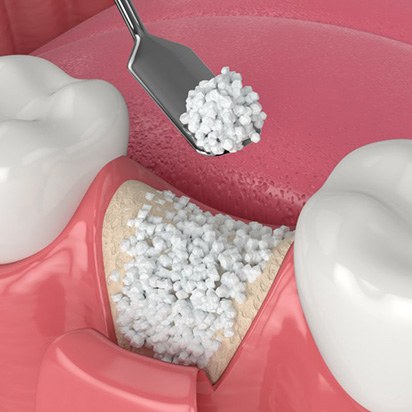 Digital image of bone grafting being placed in an empty dental socket