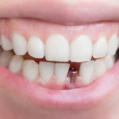 Close up of someone smiling to reveal their dental implant post
