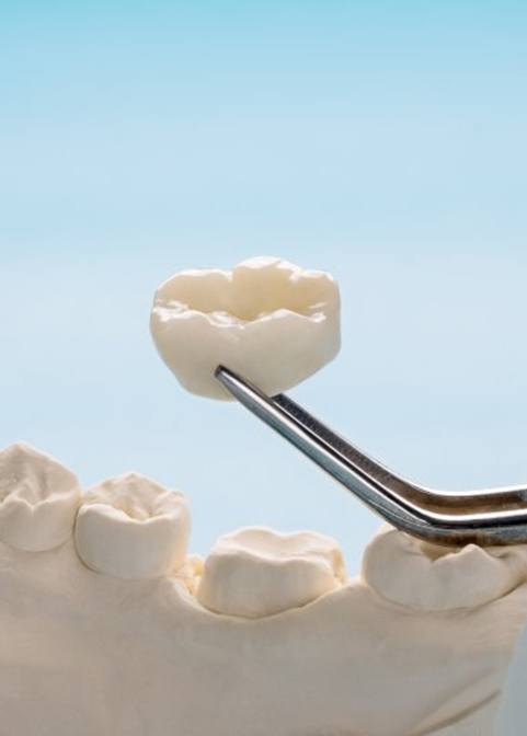 Close up of tweezers carefully holding a dental crown above a model