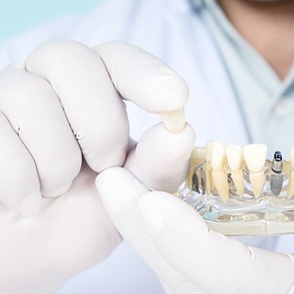Dentist wearing white holding sample dental implant