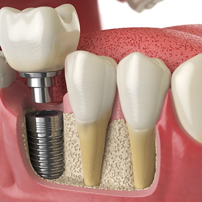 Illustration of a single dental implant and its parts in a lower jaw
