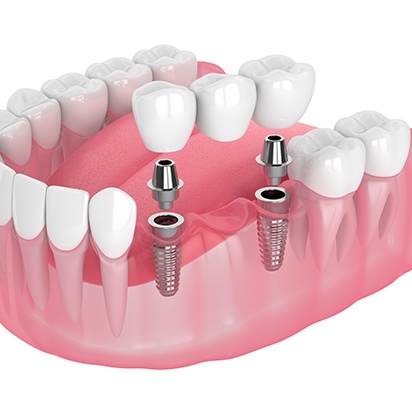 Illustration of an implant bridge with white background