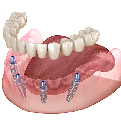 Rendering of 4 dental implants in lower jaw to anchor dentures