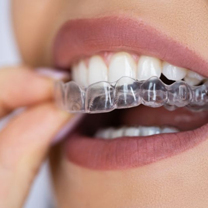 Close-up of woman’s mouth as she places Invisalign aligner on her teeth