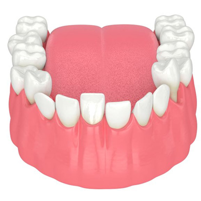 Illustration of crowded teeth