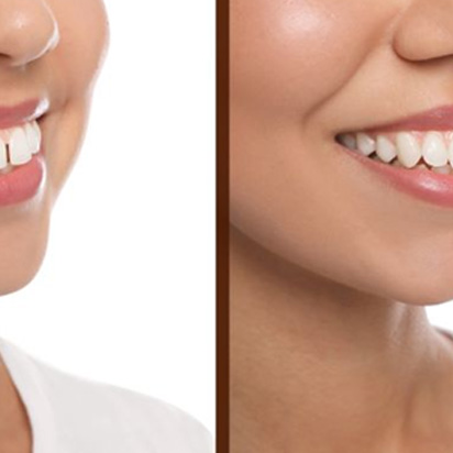 Woman’s smile before and after closing the gap between her teeth