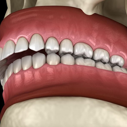 Digital image of a patient’s overbite