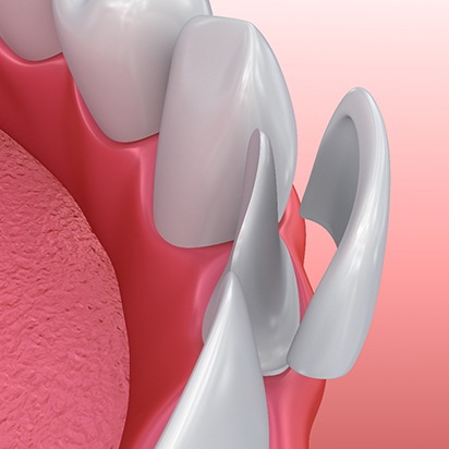 Illustration of tooth getting a veneer
