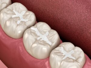 Dental fillings.