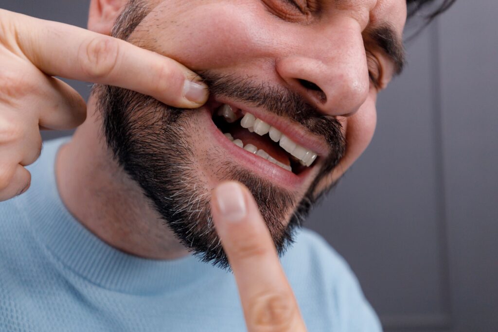Closeup of man pointing to a gap in his grin left by missing tooth