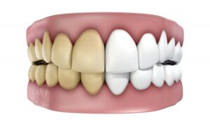 Rendering of teeth, half of them discolored. 