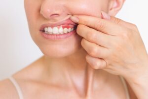 Nose-to-shoulder closeup of woman pulling back upper lip to reveal dark red gums